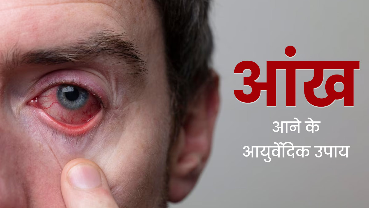 आंख आने की समस्या (कंजक्टिवाइटिस) होने पर आजमाएं ये 5 आयुर्वेदिक उपाय, जल्द दूर होगा संक्रमण
